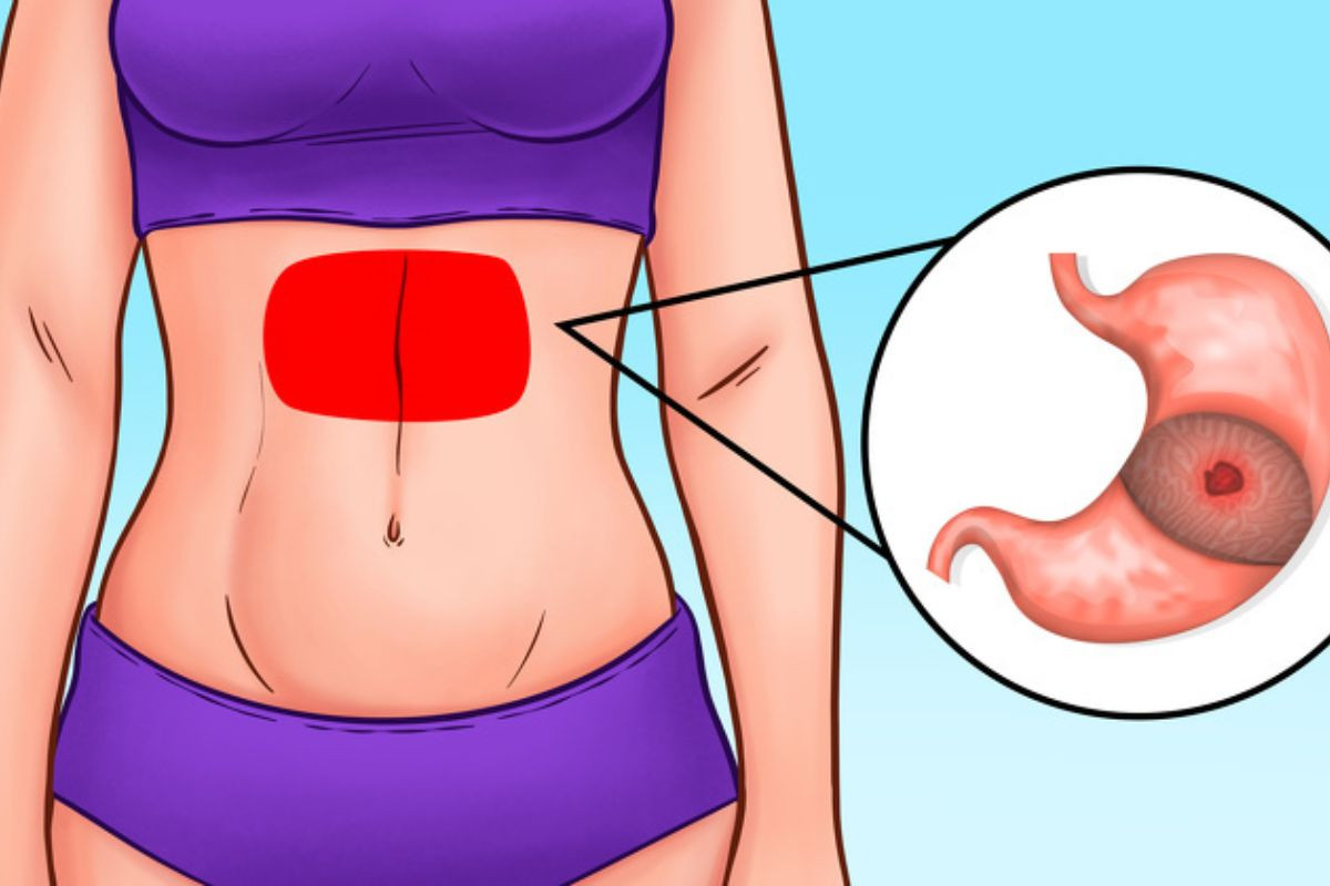 Bệnh đau ruột thừa chuyển biến nặng sẽ gây nên triệu chứng sưng phồng vùng bụng