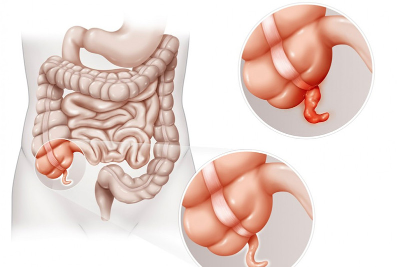 Tắc nghẽn ở lỗ thông giữa ruột thừa và manh tràng là nguyên nhân chính gây đau ruột thừa ở nữ