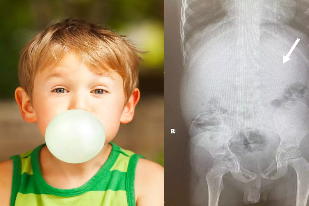 Một cậu bé ở Mỹ đã nuốt 40 viên kẹo cao su và phải đi cấp cứu sau đó