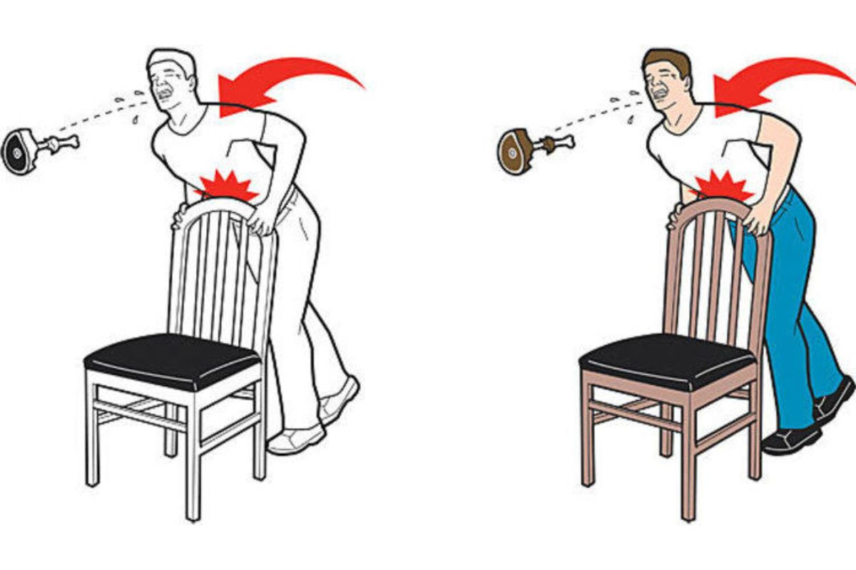 Cách trị xương cá mắc cổ họng bằng nghiệm pháp Heimlich